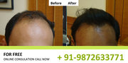 NHT hair transplant clinic Lucknow offering huge discount on Surgery