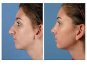 Best Nose Job Surgeons In Lucknow