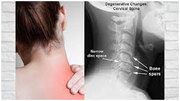 Cervical Radiculopathy | Neck Pain Treatment Meerut