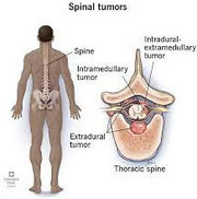 Spine Tumor Surgery in Meerut